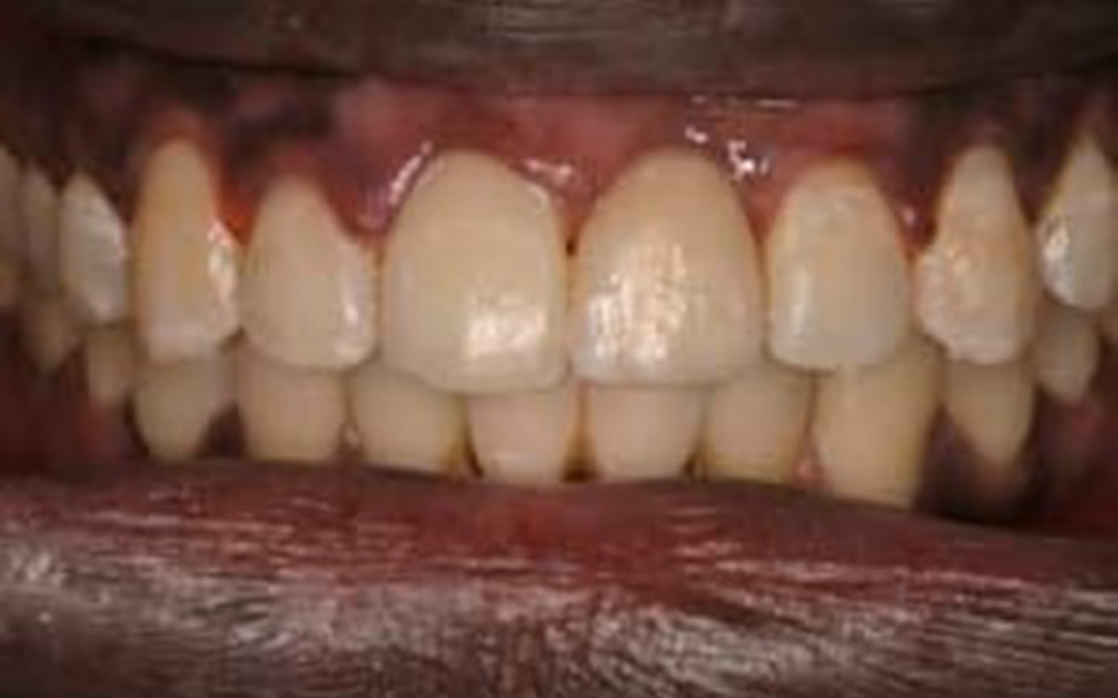 Close-up of upper and lower front teeth with inflamed, red gums indicating possible gingivitis.