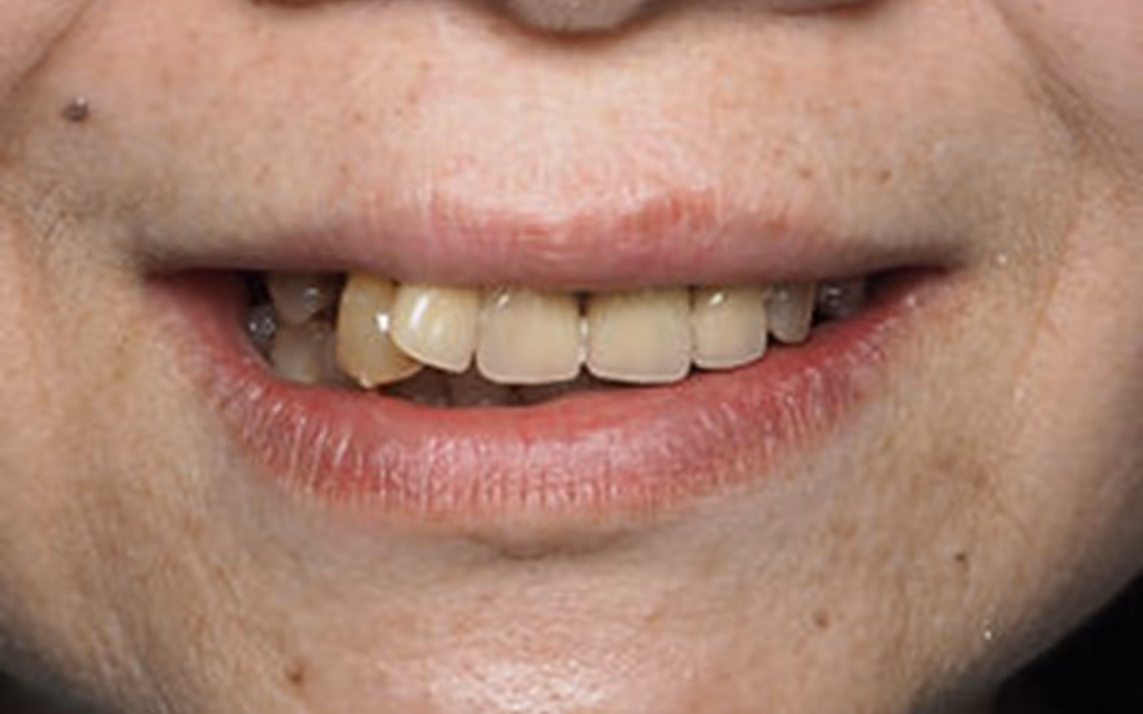 Close-up of a person's smile showing uneven, yellowed front teeth with one tooth misshapen.