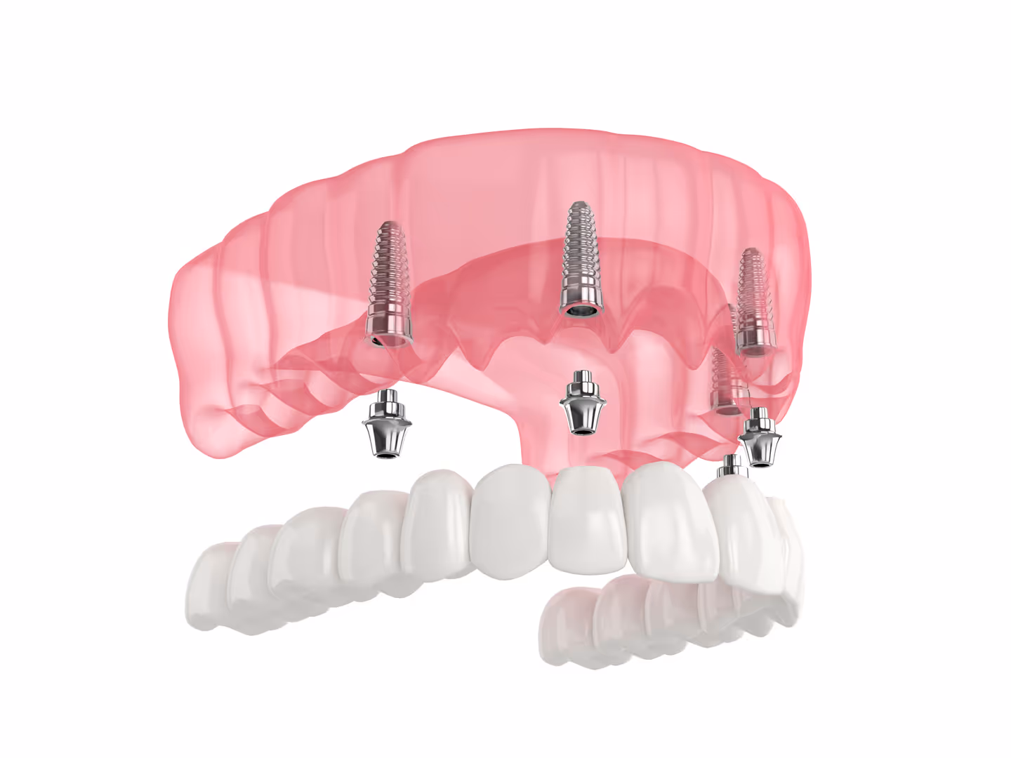 All-on-4 Dental Implants in Renton, WA – A Permanent Solution for Missing Teeth