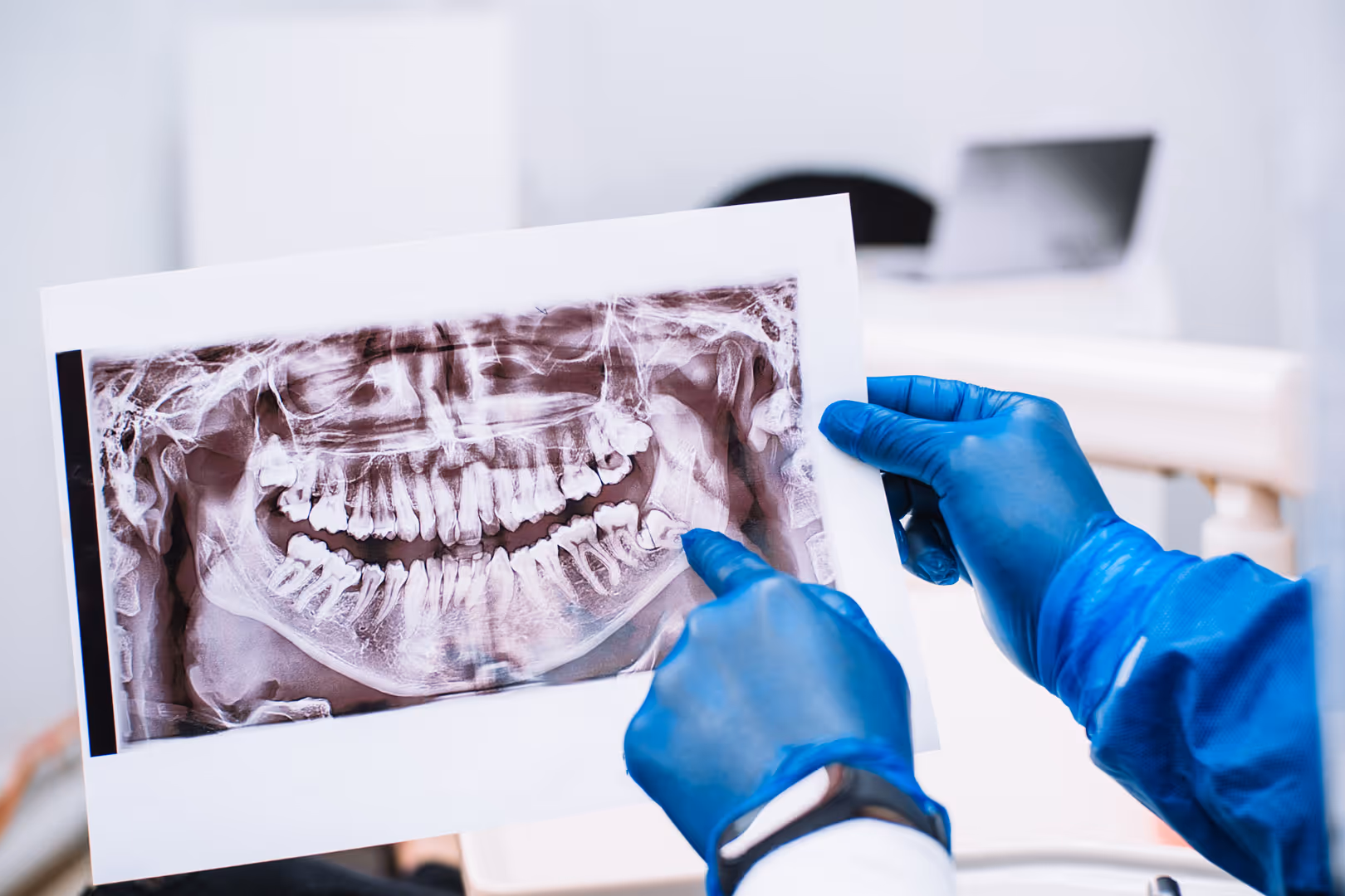 Wisdom Teeth Extractions in Renton, WA