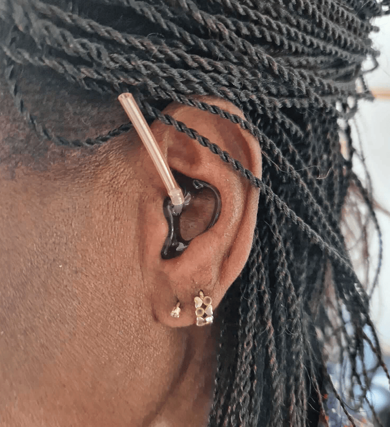 A Custom Earmould Fitting on a patient's ear