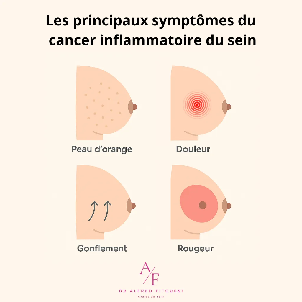 symptômes du cancer inflammatoire du sein