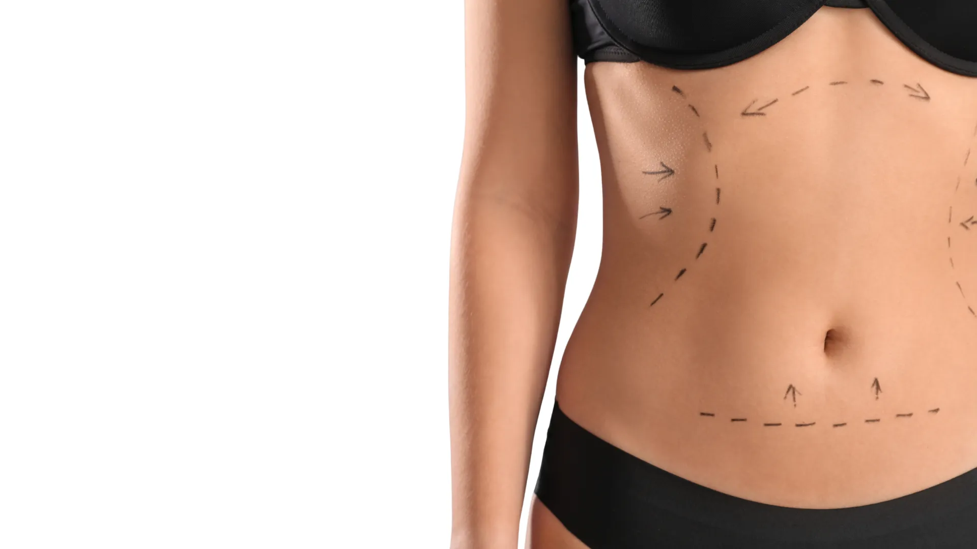Prise en charge d'une abdominoplastie