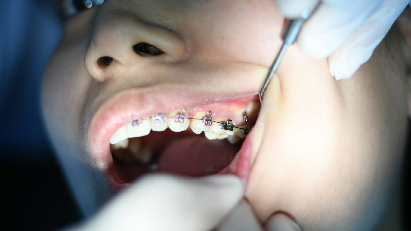 person with silver teeth braces