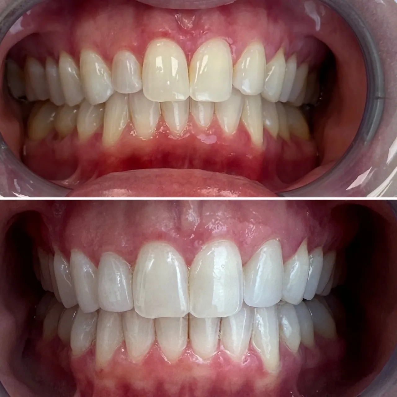 Before & after results from a real patient of Skyline Dental Designs