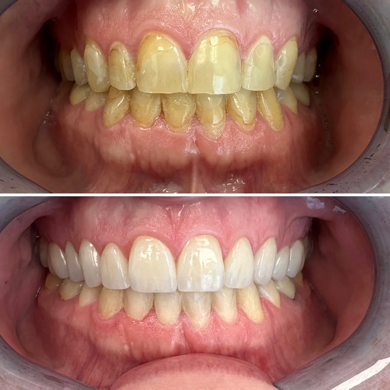 Before & after results from a real patient of Skyline Dental Designs