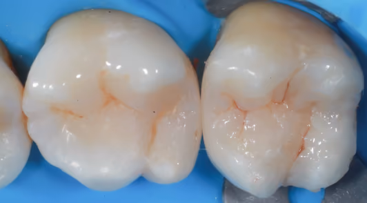 Completed restored tooth