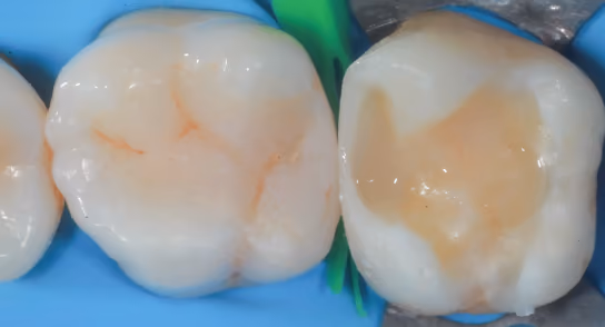 Fill the cavity with tooth-colored composite resin