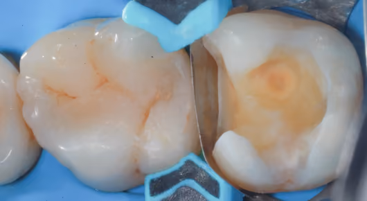 Remove the tooth decay and rebuild the wall