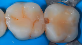 Dental cavity on the side of the tooth