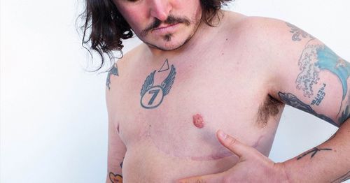 Topectomie How Much Pain Can I Expect After Top Surgery? | McLean Clinic