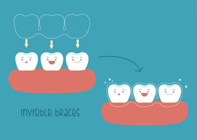 The Facts From an Invisalign® Dentist