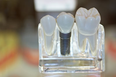 What You Should Know About Implant Dentistry