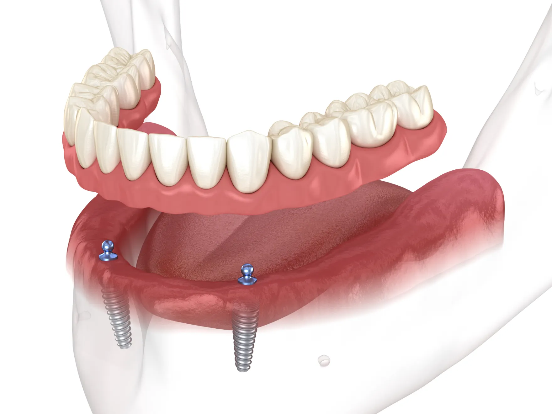 All-on-X Dental Implants
