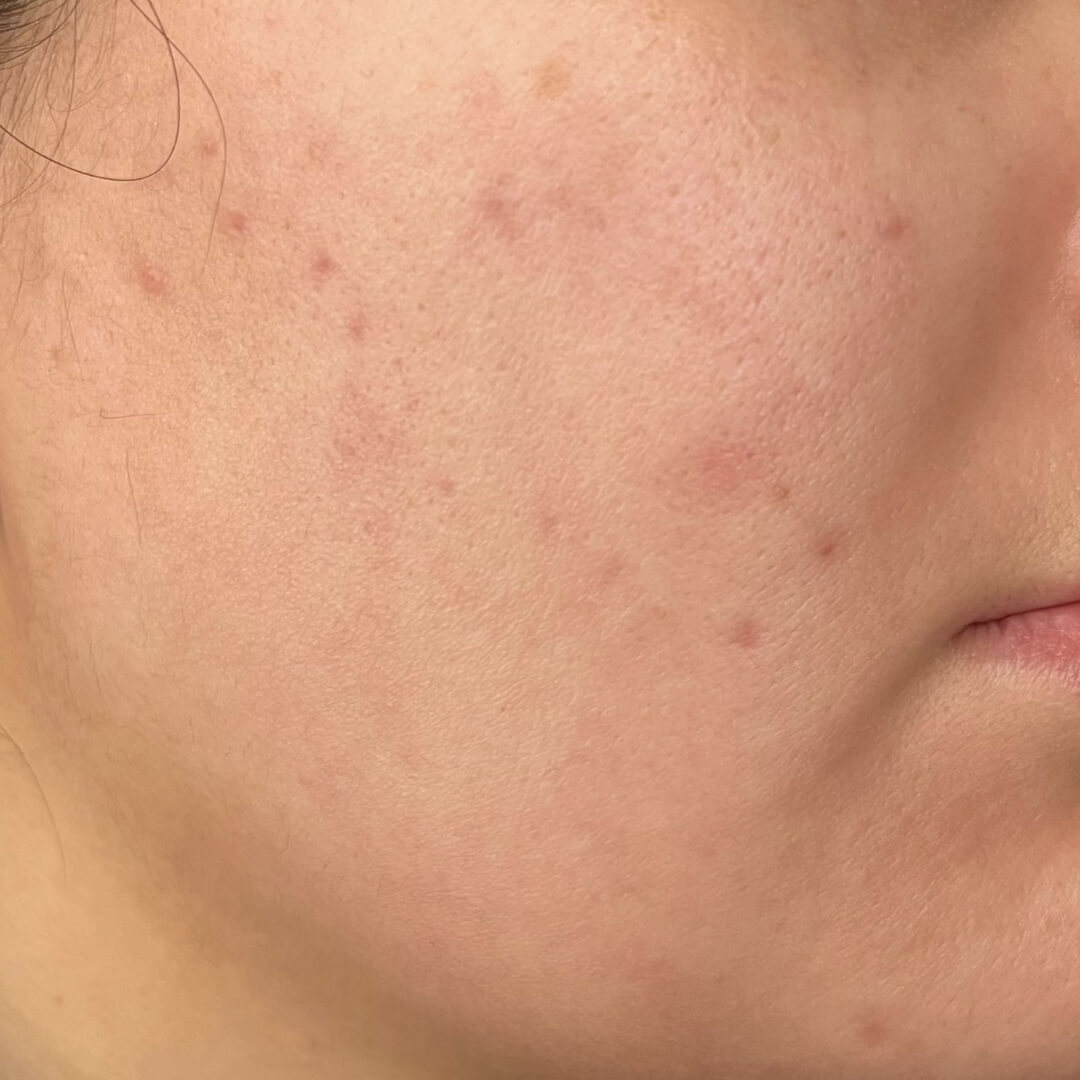 Acne Treatment