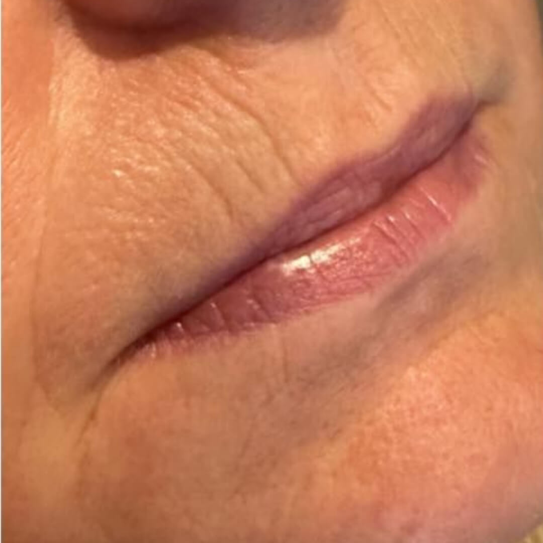 Lip Enhancement