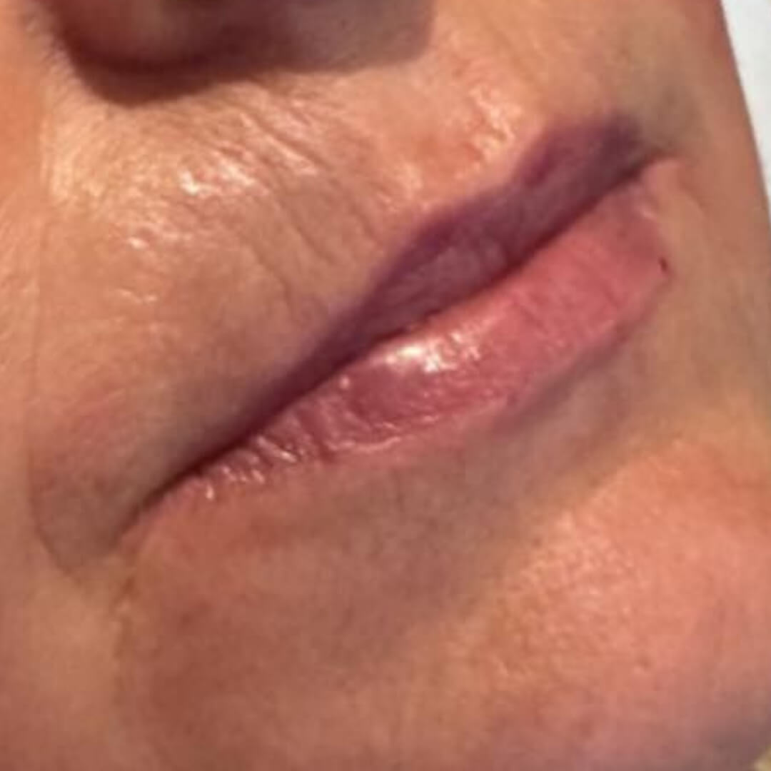 Lip Enhancement