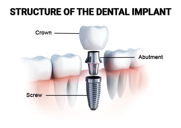 Dental implant model showing components of tooth replacement