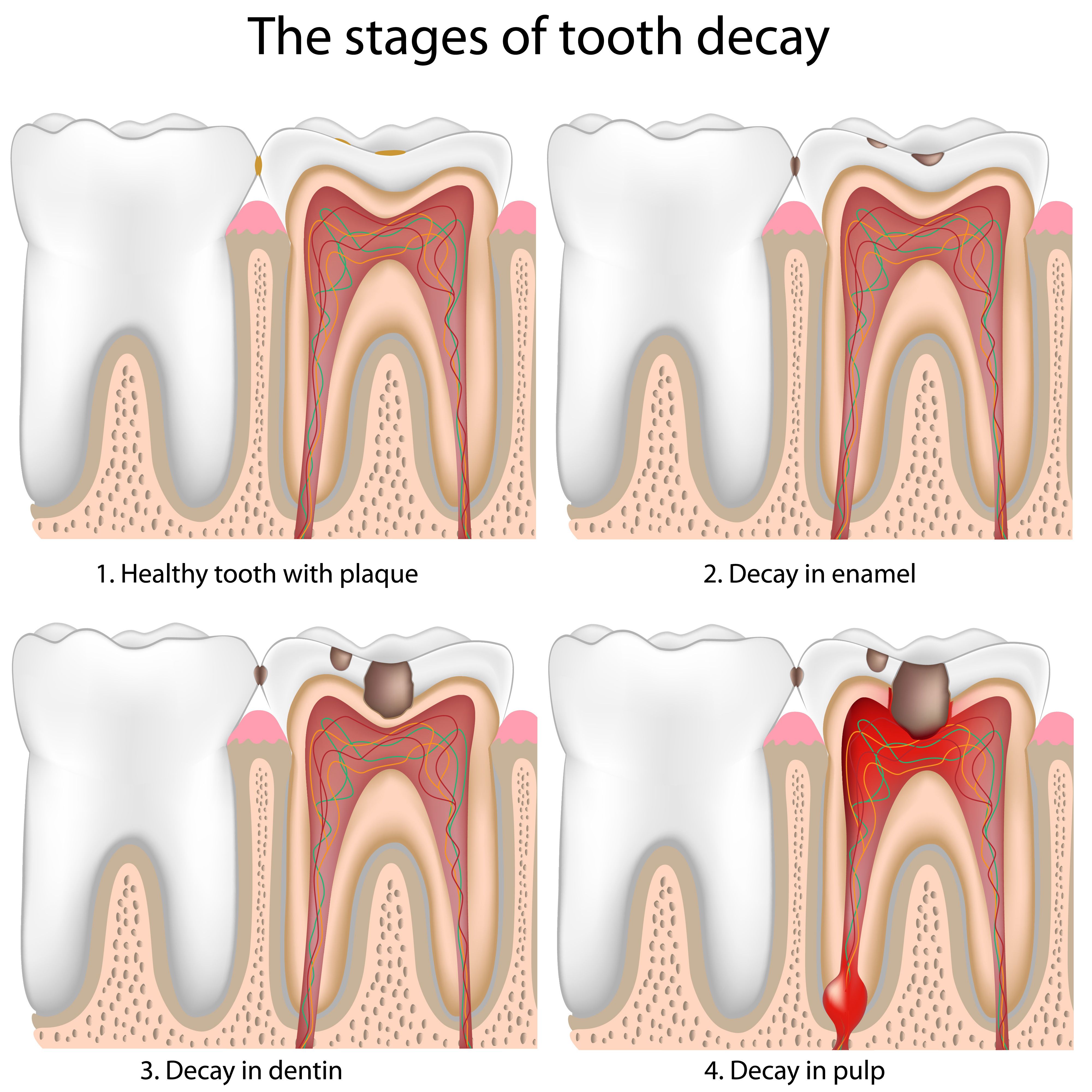 Diagram showing stages of a dental cavity from early enamel decay to advanced decay and tooth pain.