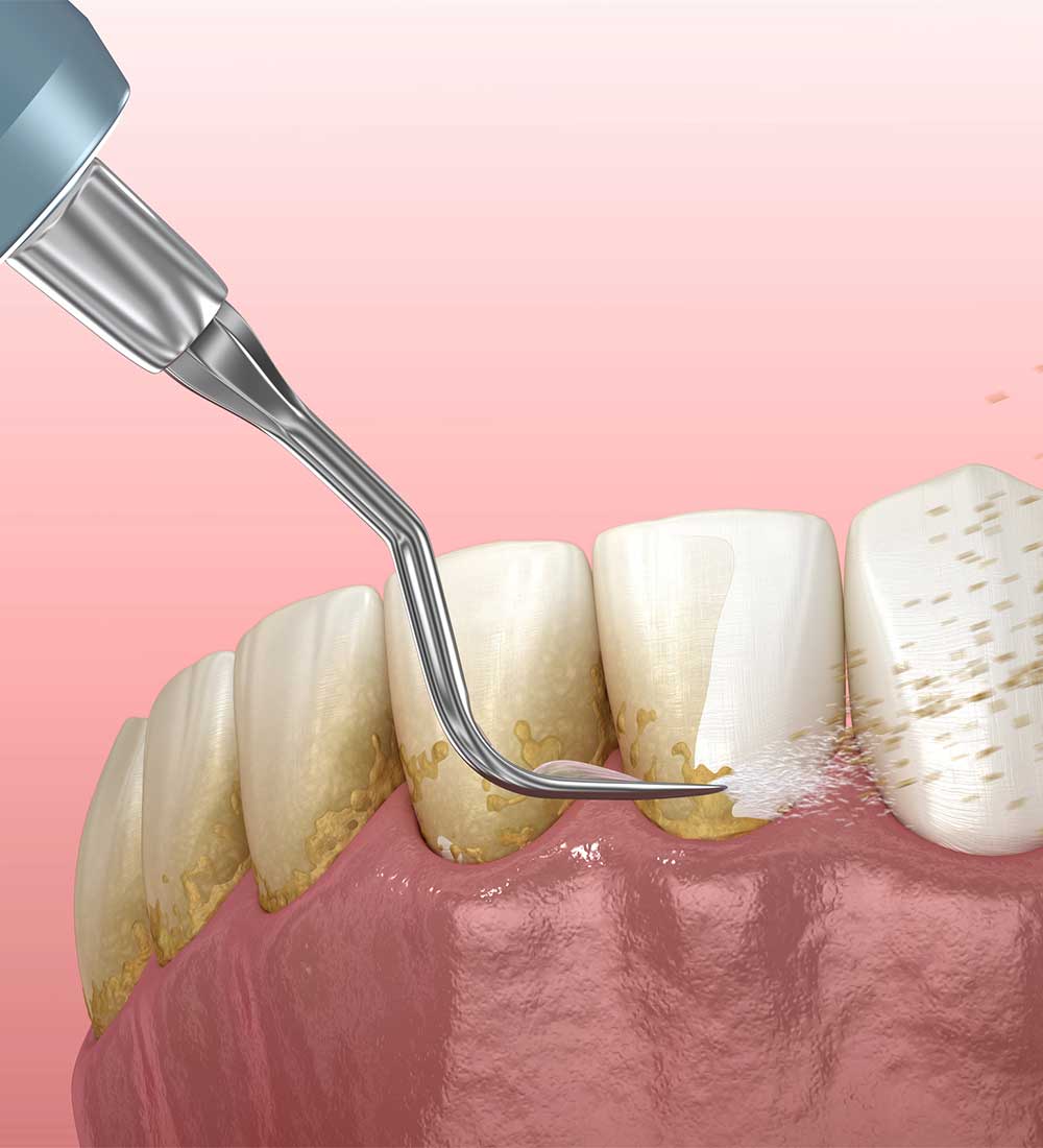 Close-up of scaling and root planing or periodontal instruments in use