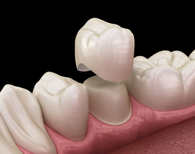 Dentist placing ceramic crown to restore tooth strength and function.