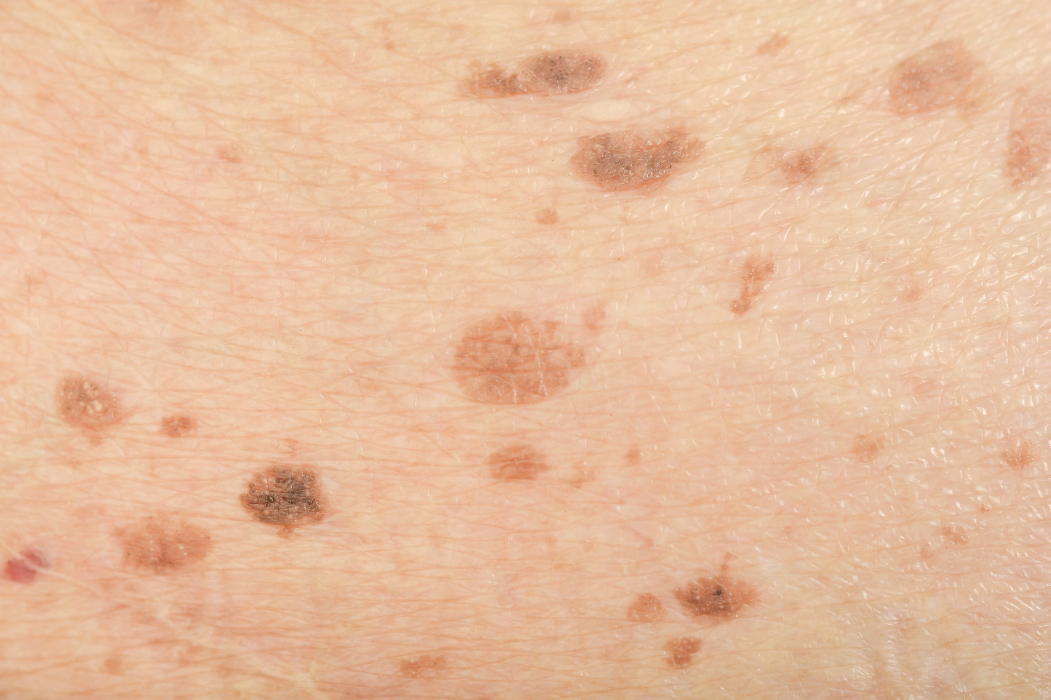 Dark Spots Columbus Ohio