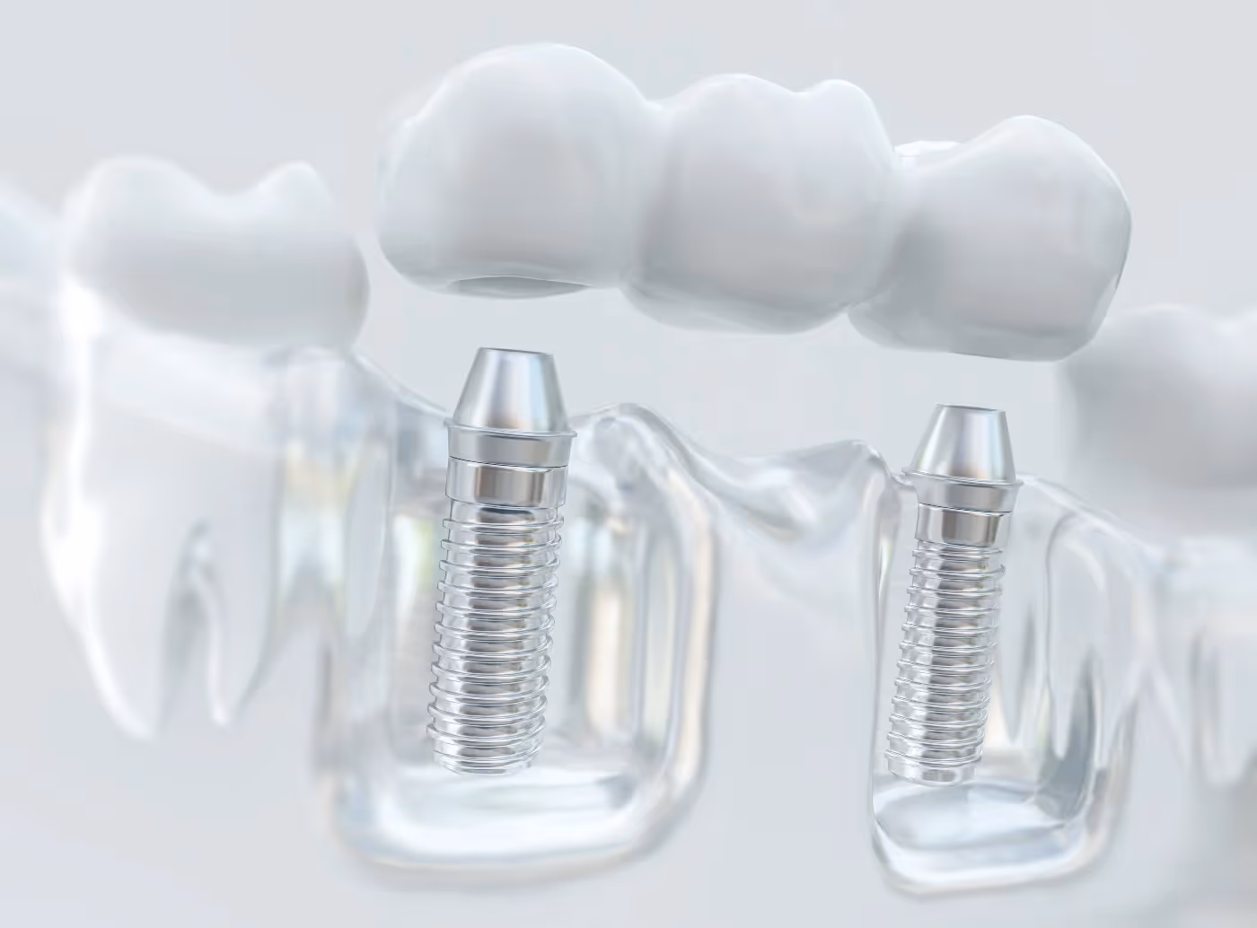 dental implants Camby