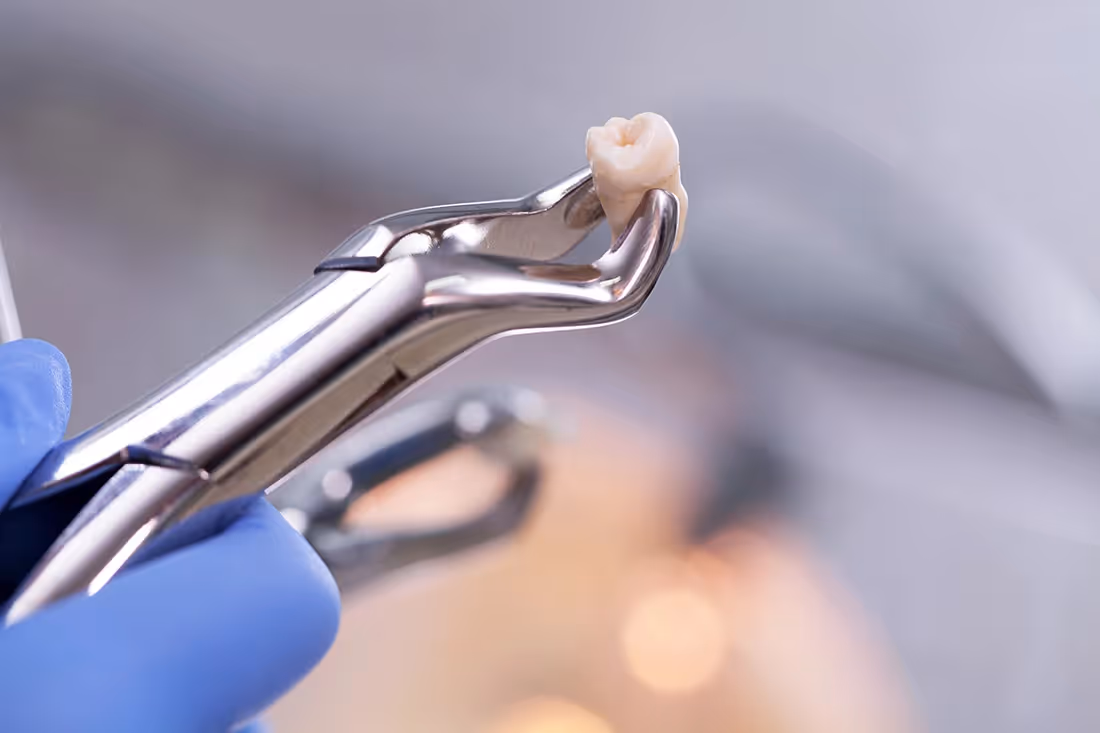 Tooth Extractions in Camby, IN | Dental Wellness