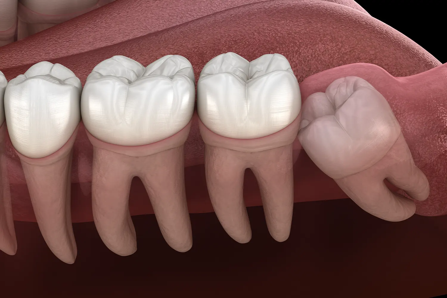 Wisdom Tooth Removal in Camby | Dental Wellness of Camby