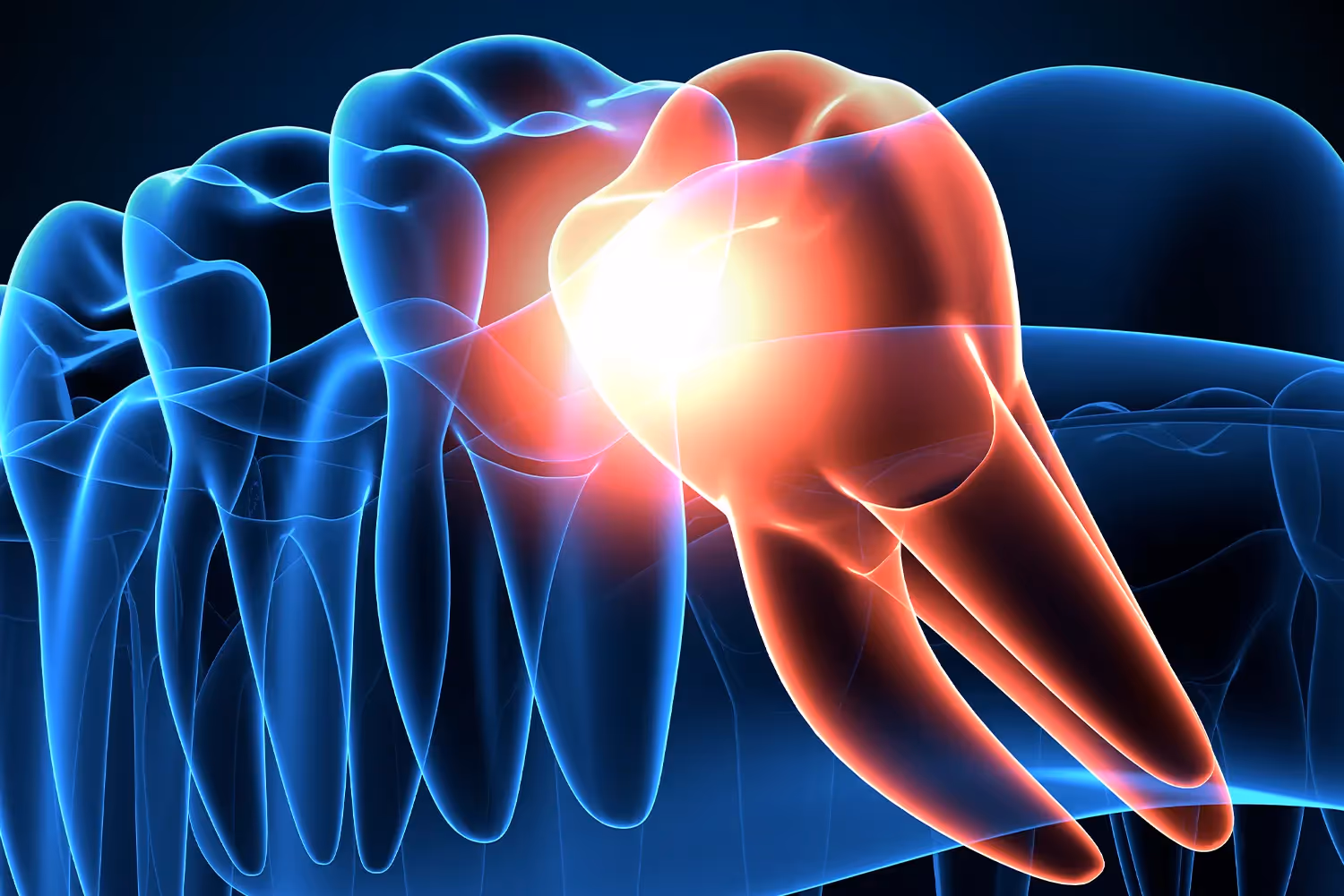 Wisdom Tooth Removal in Camby | Dental Wellness of Camby