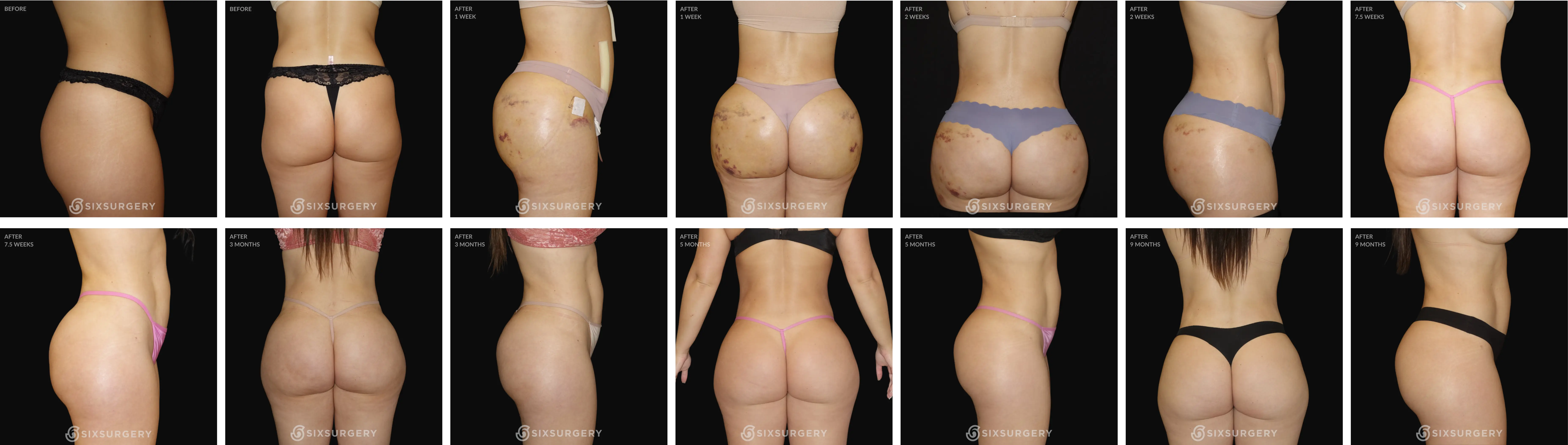 BBL Healing Process: 1 Year Timeline