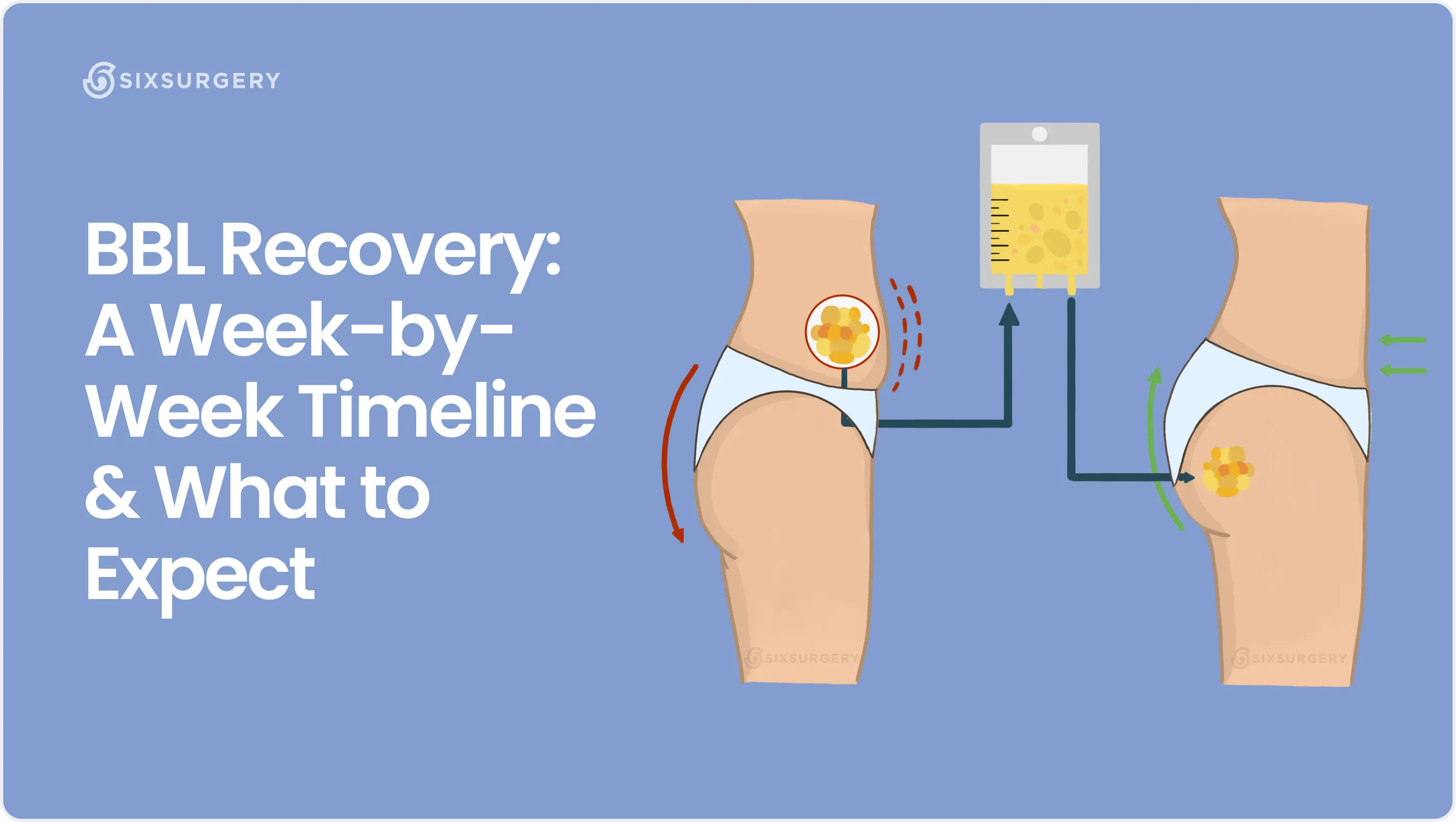 BBL Recovery: A Week-by-Week Timeline & What to Expect