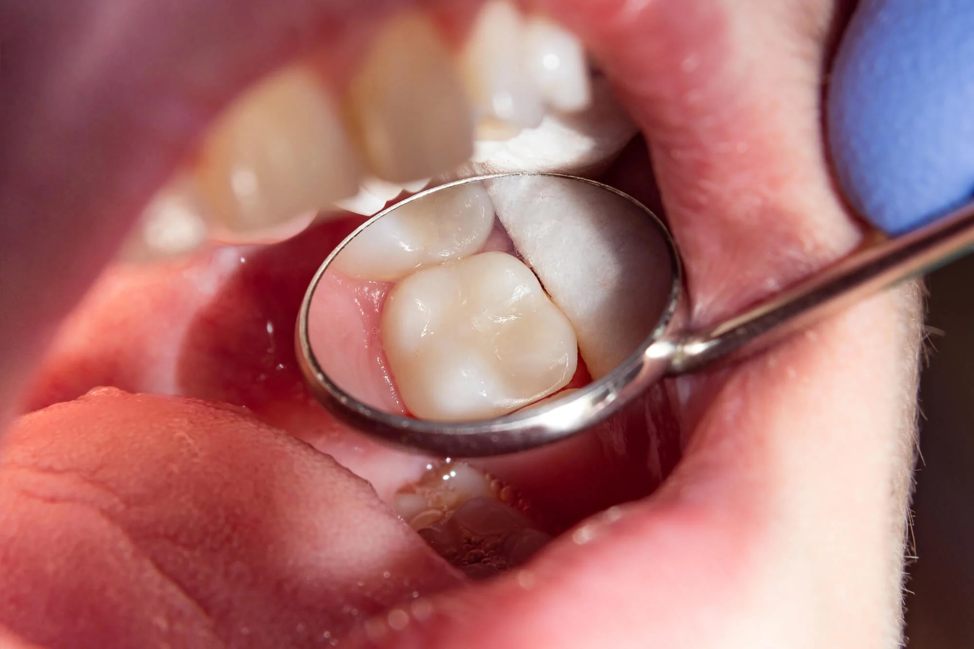 Tooth exam for tooth fillings near me
