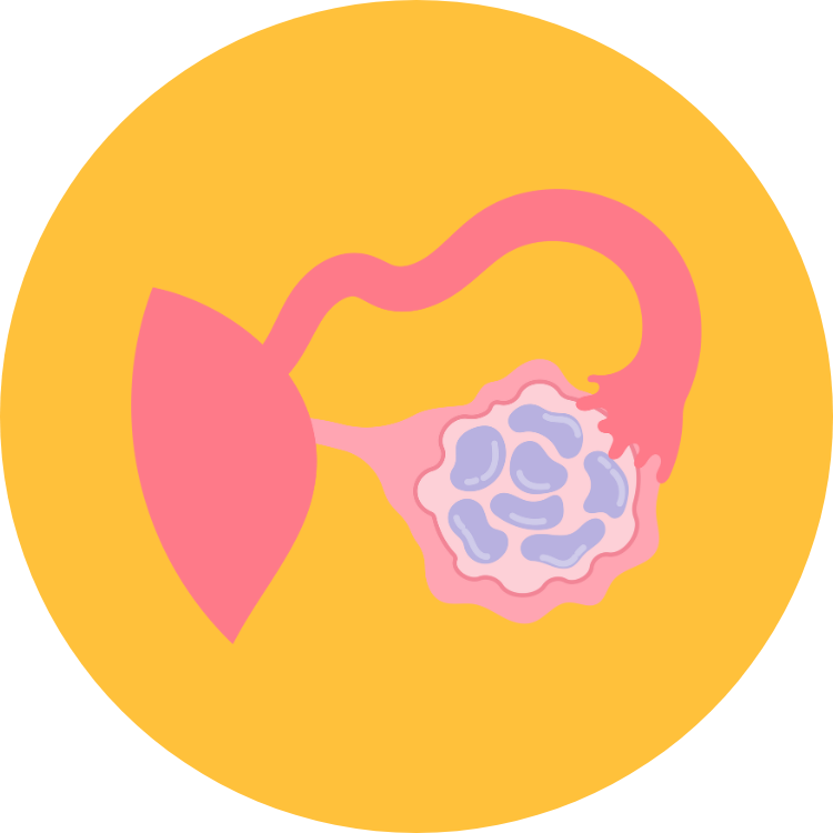 Ovarian cancer