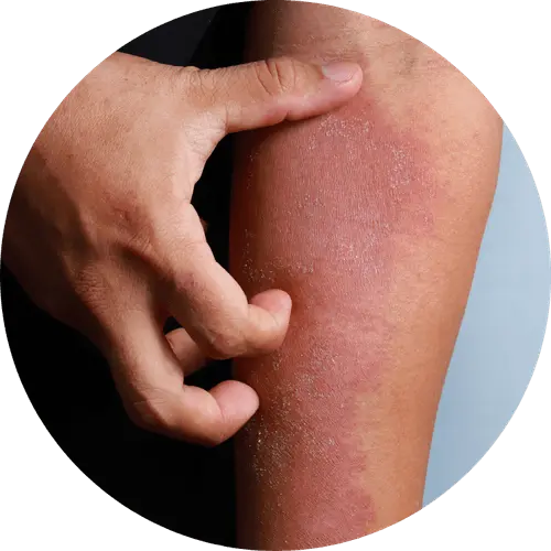 inflammatory skin diseases 