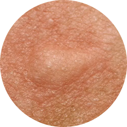 maladies tumorales cutanees