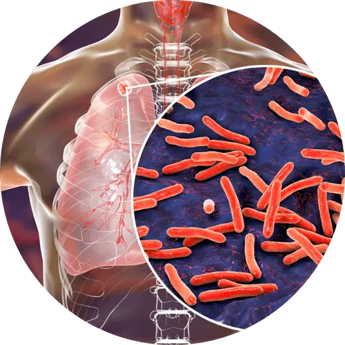 maladies pulmonaires infectieuses chroniques