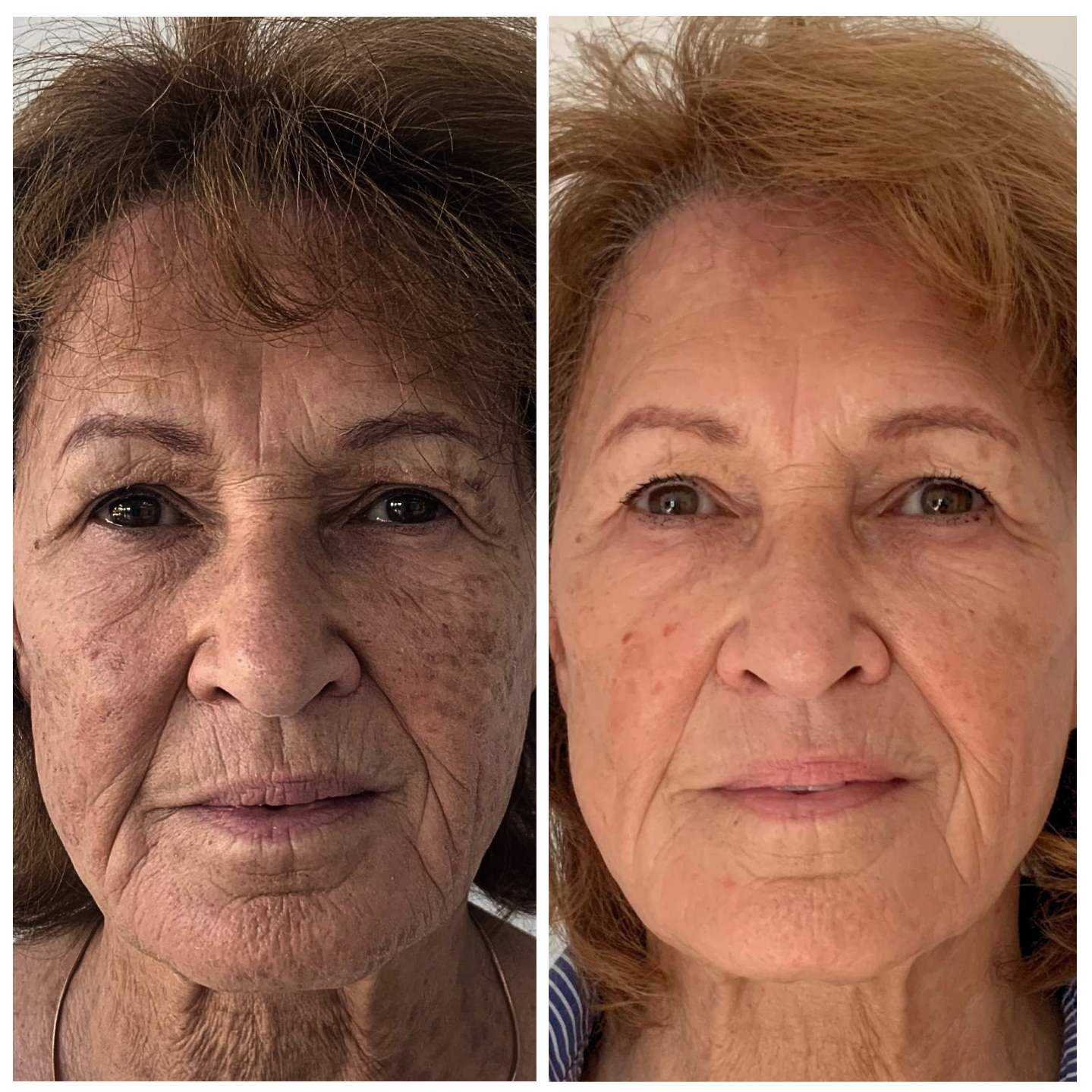 Side-by-side close-up portraits of an elderly woman before and after skin treatment or photo enhancement.