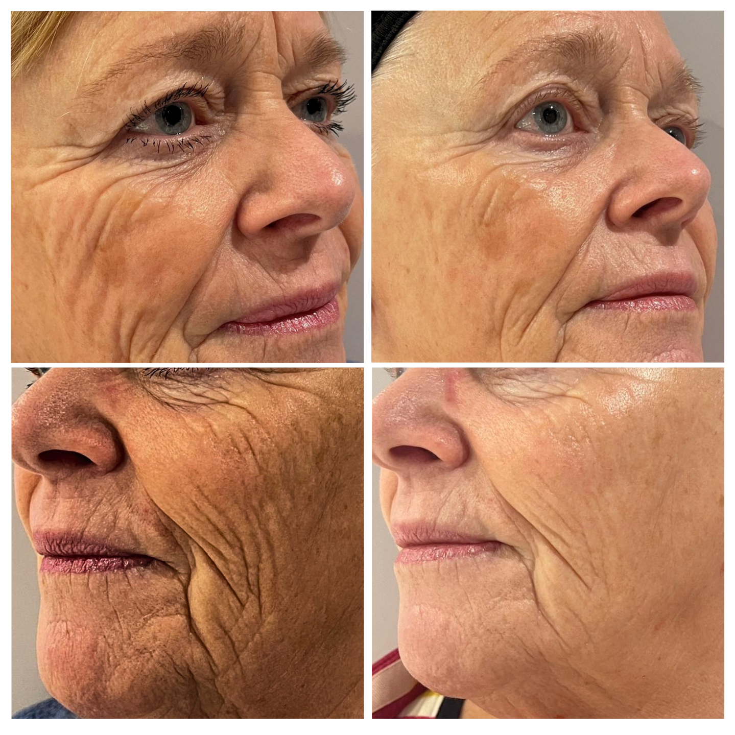 Close-ups of elderly woman's face showing wrinkles and age spots on cheeks from different angles.