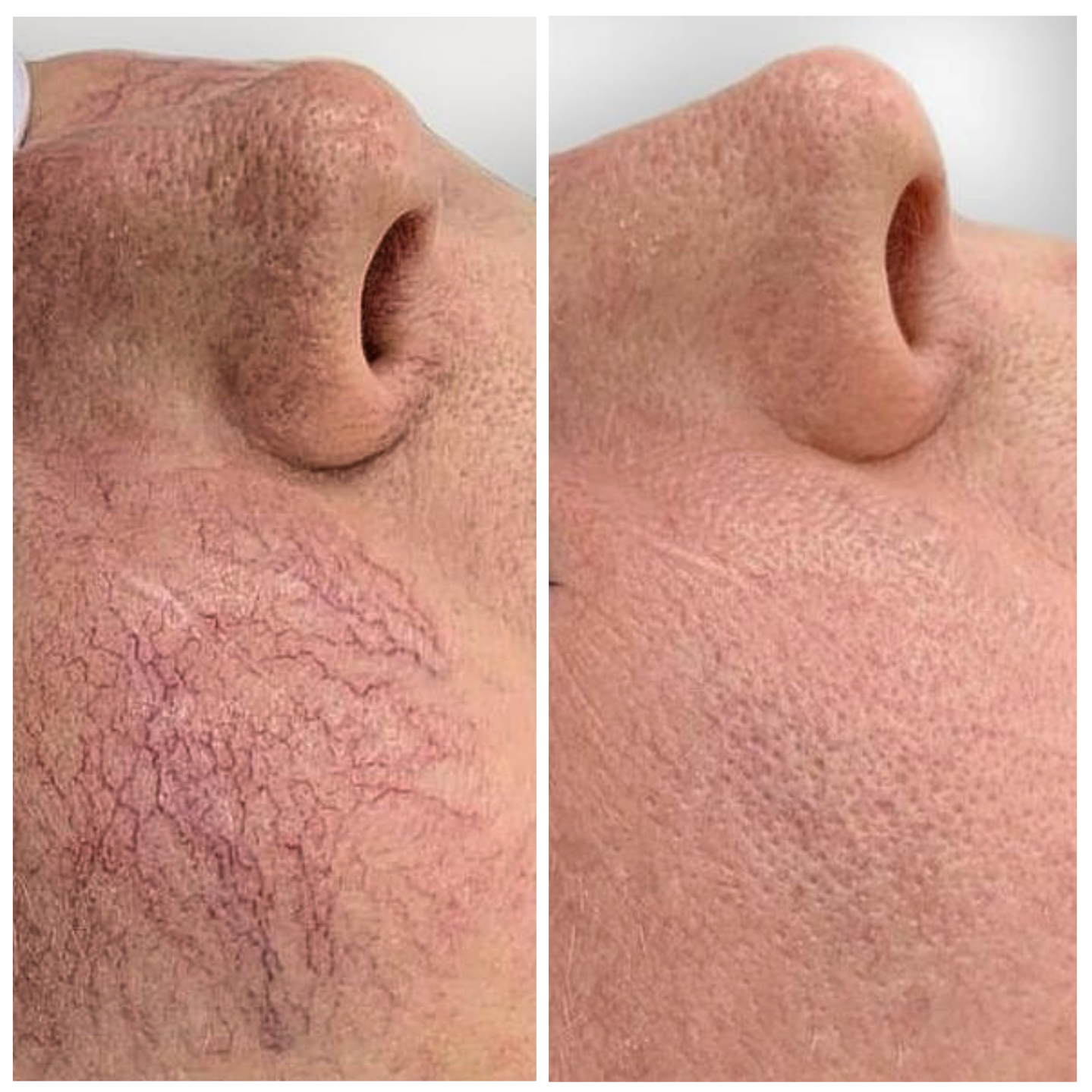 Side-by-side close-ups of a nose and cheek showing visible spider veins on left and clearer skin on right.