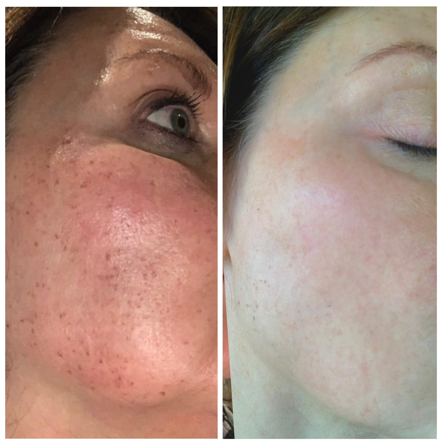 Side-by-side close-ups of a woman's cheek showing skin with freckles and redness before and clearer after treatment.