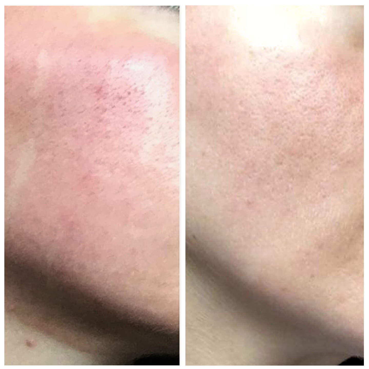 Side-by-side close-up of cheek showing reduced redness and smoother skin texture before and after treatment.