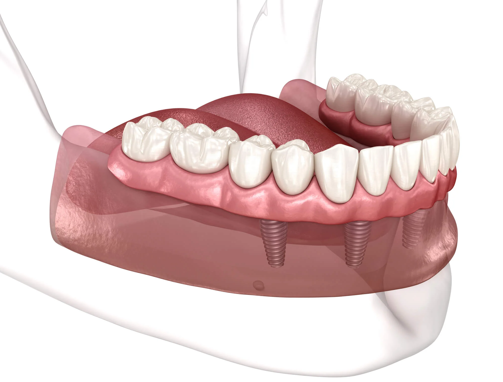 Prosthesis supported by all-on-4 dental implants in Vienna
