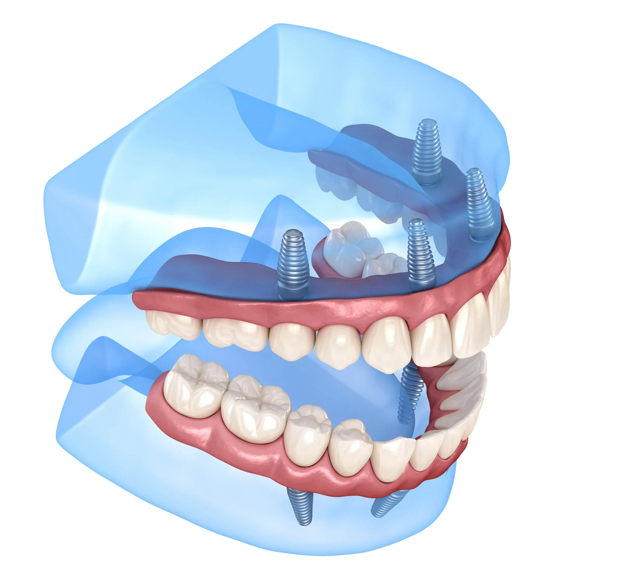 Removable full-arch prosthesis supported by all-on-4 dental implants in Vienna