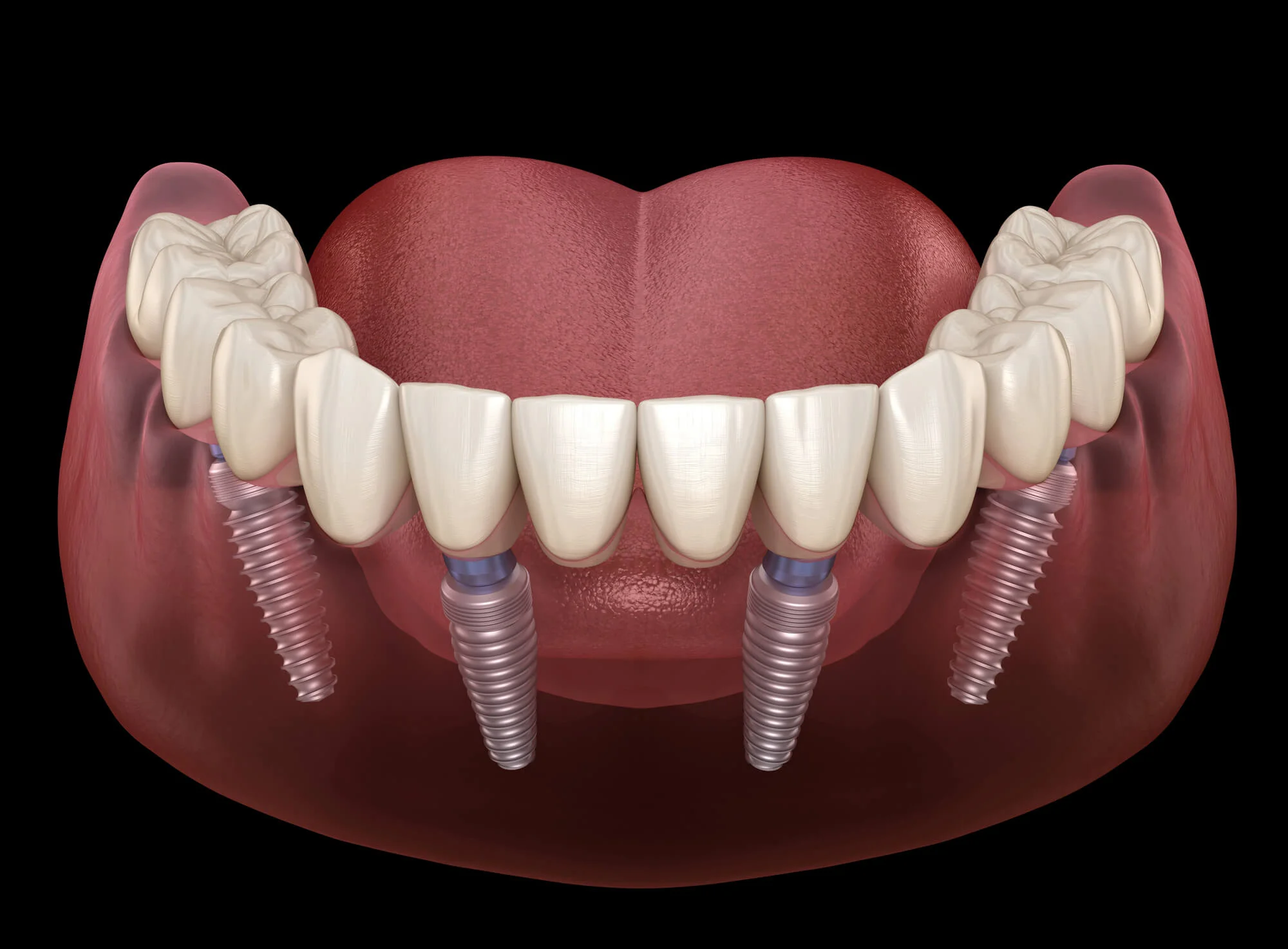 Maxillary & mandibular prosthesis supported by all-on-4 dental implants in Vienna