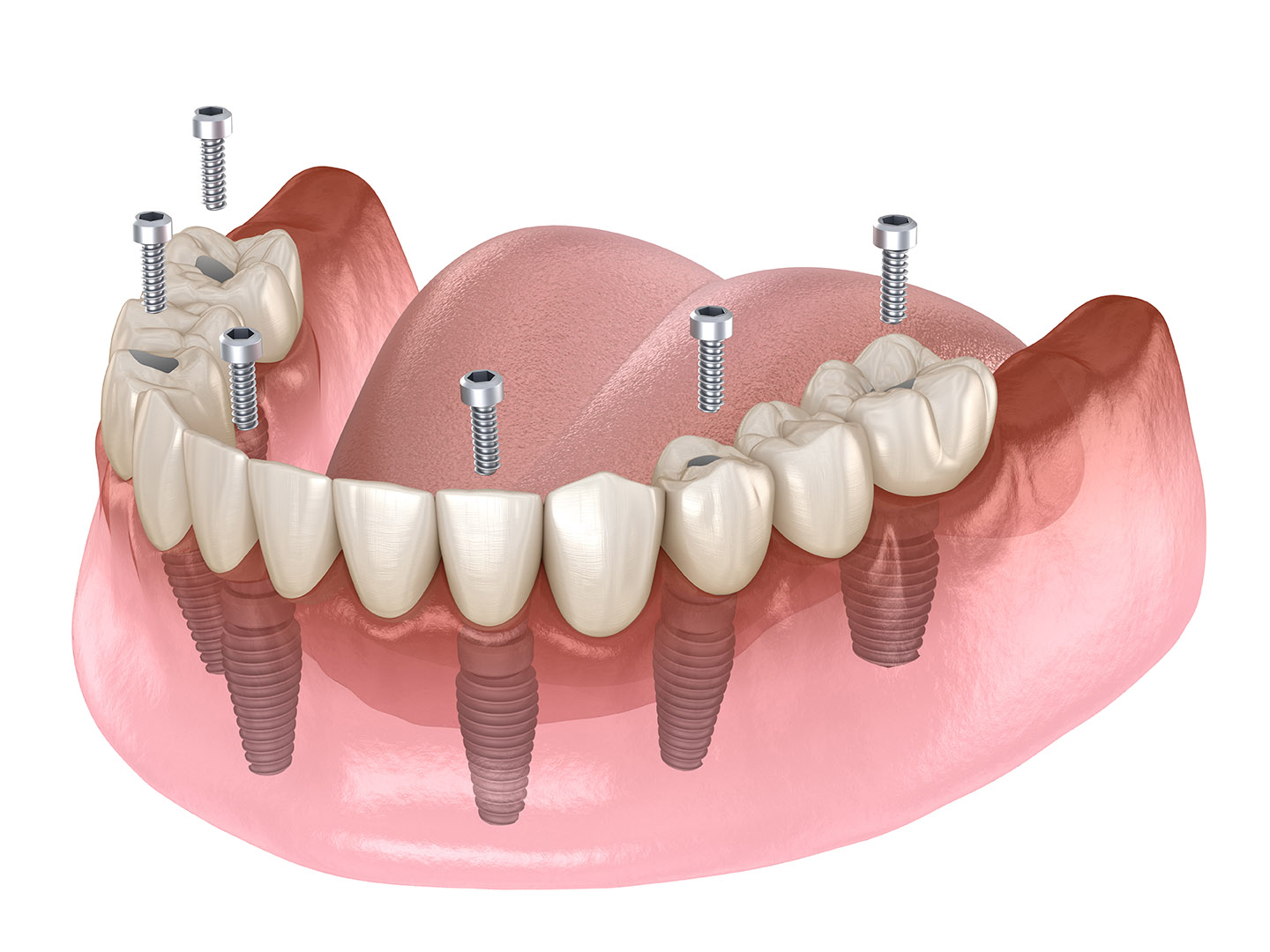 All-on-4 Implants in Vienna, VA