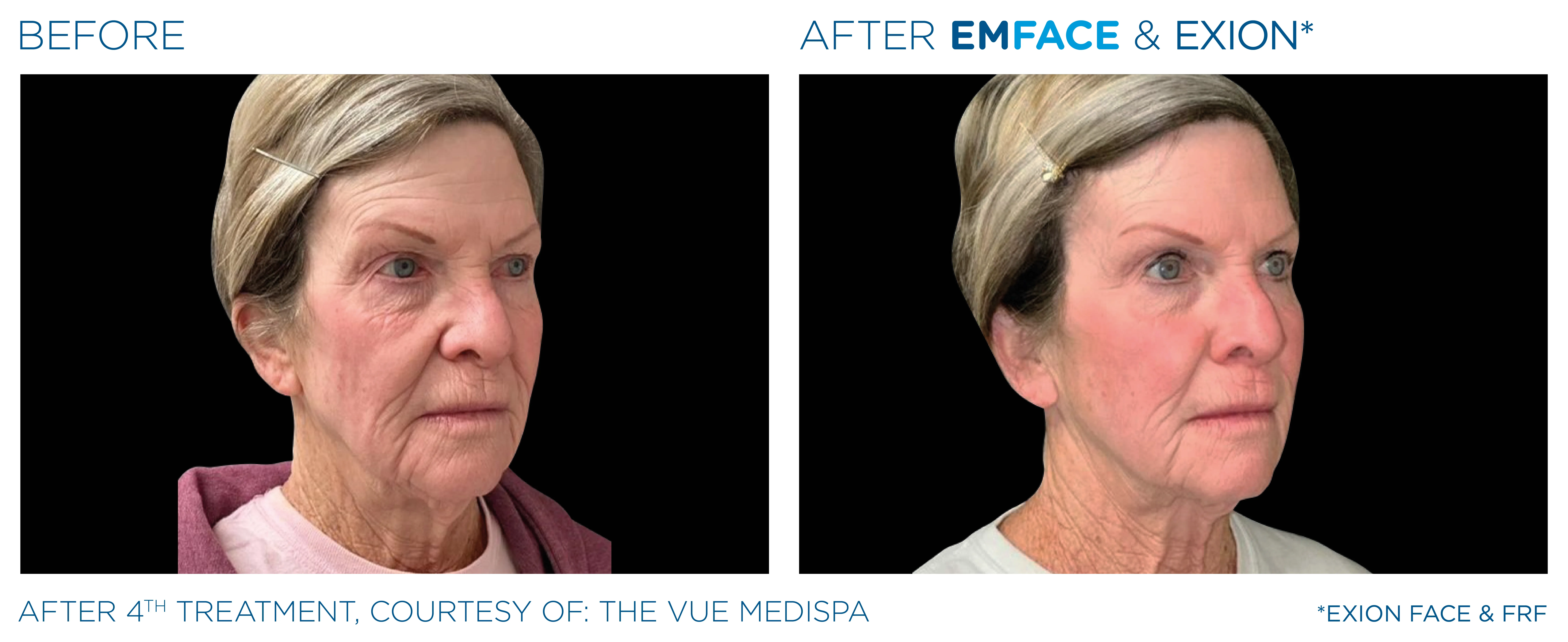 Side-by-side before and after images of an older woman showing reduced facial wrinkles and improved skin firmness after four EMFACE and EXION treatments.