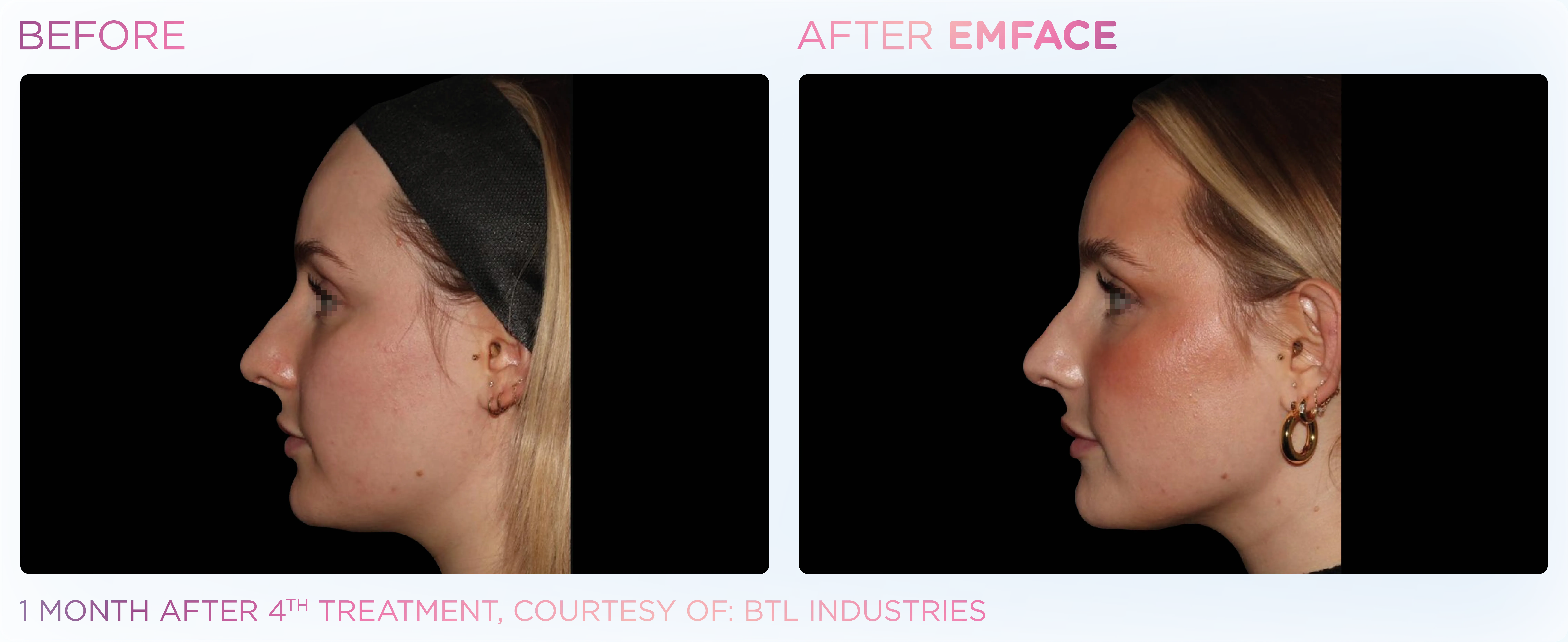 Side-by-side comparison of a woman’s face before and after four EmFace treatments, showing reduced facial wrinkles and a smoother jawline.