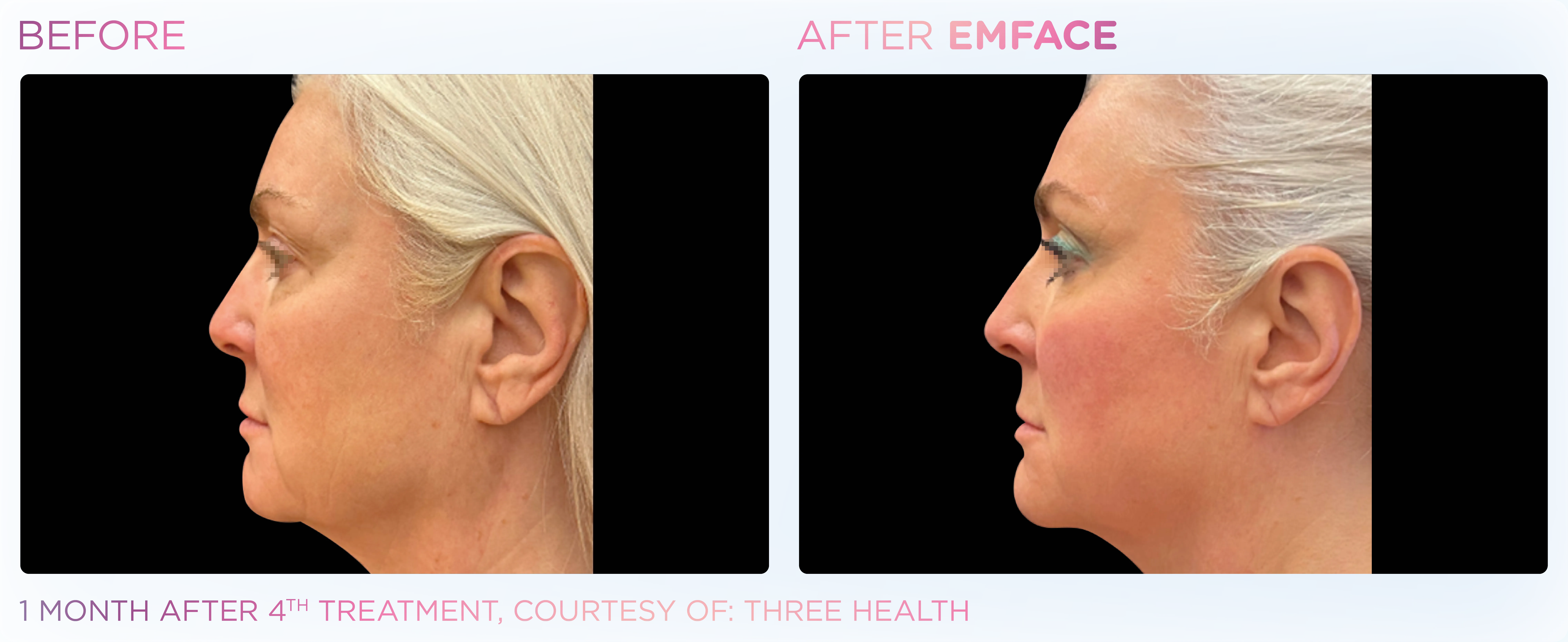 Side-by-side profile comparison of a woman before and one month after the fourth Emface treatment, showing a firmer jawline and smoother skin tone after treatment.