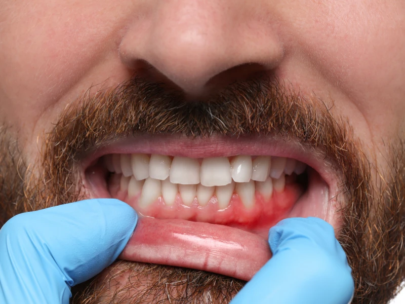 Patient enquiring about our gum graft surgery in Greenville, TX.